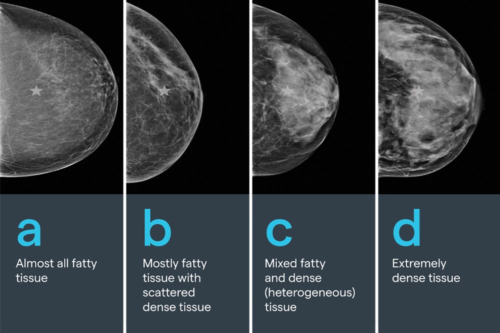 Do You Know Your Breast Density?